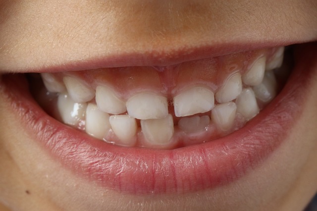 虫歯を防ぐために何をすべき？知っておきたい心構えをご紹介！